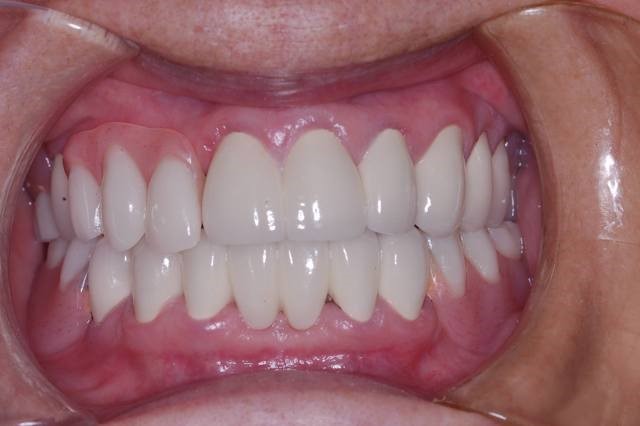 Flexible Partial Dentures Richmond VA 23233